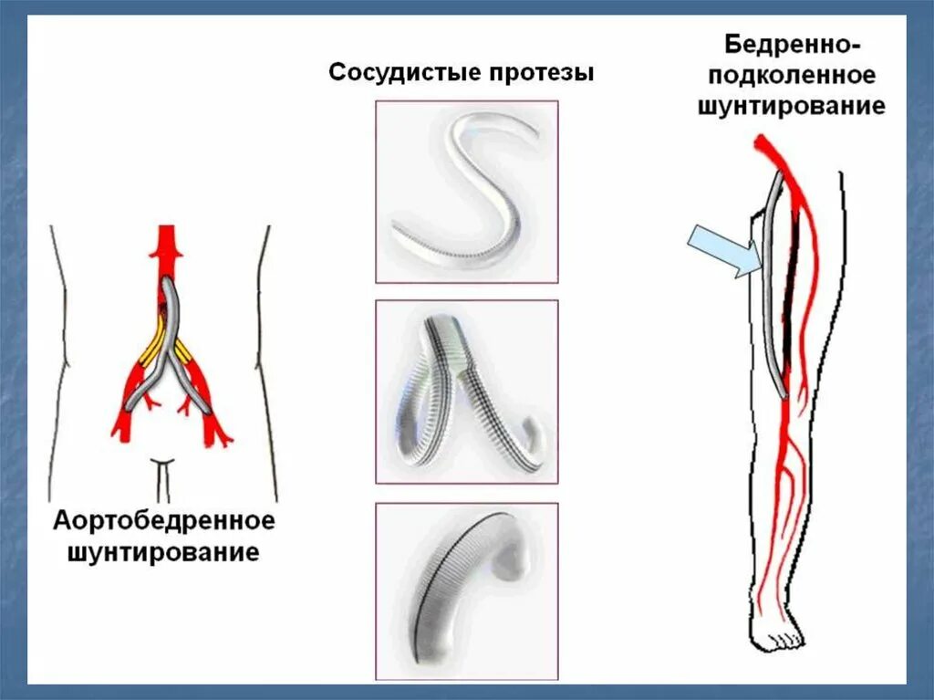 Шунт сосудов. Проксимальное бедренно подколенное шунтирование. Операция бедренно подколенное шунтирование. Шунтирование сосудов нижних конечностей. Шунтирование атеросклероза нижних конечностей.