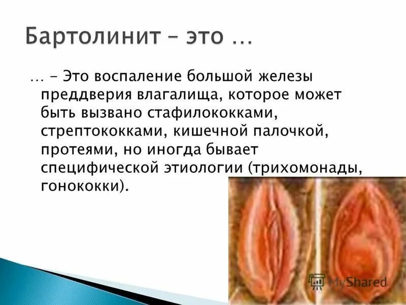 Бартолиновые железы воспаление фото лечение Киста шейки матки: опасно ли это и как ее лечить (множественные в том числе) afg