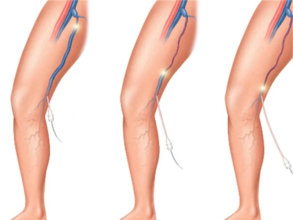 Эндовенозная лазерная облитерация вен нижних конечностей. Радиочастотная облитерация нижних конечностей. Варикозное расширение вен нижних конечностей БПВ. Тромбоз бпв