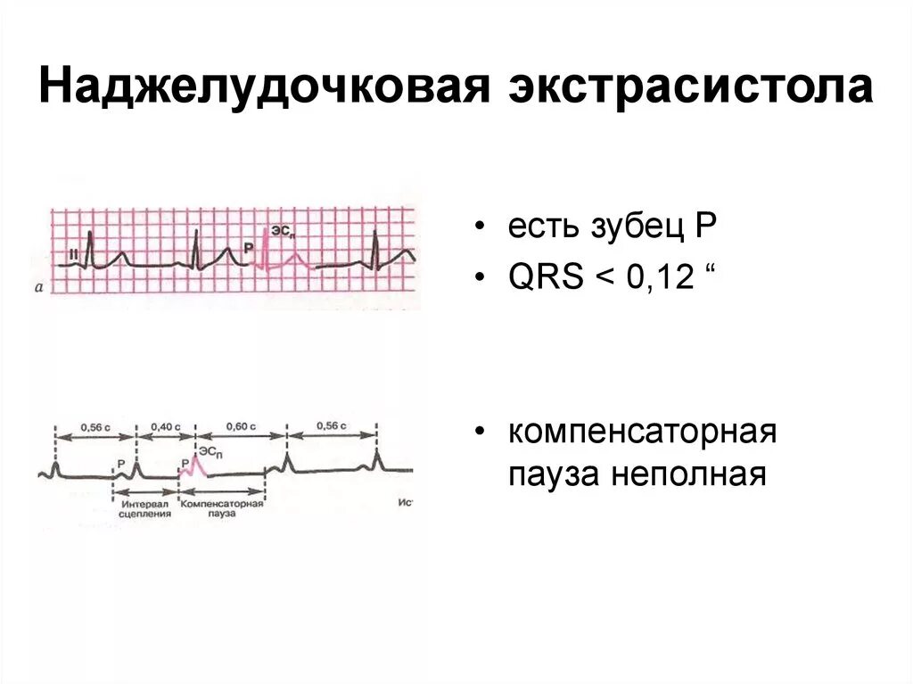 ЭКГ критерии наджелудочковой экстрасистолии. Наджелудочковая экстрасистолия на ЭКГ. Одиночная наджелудочковая экстрасистолия на ЭКГ. Наджелудочковые и желудочковые экстрасистолы на ЭКГ. Экстрасистолы ощущения