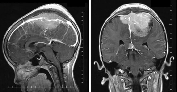 Объемное образование головного мозга код. Менингиома лобно-теменной области. Мрт.. Менингиома теменной доли. Конвекситальные менингиомы мрт.