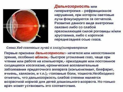 Анизометропия степени