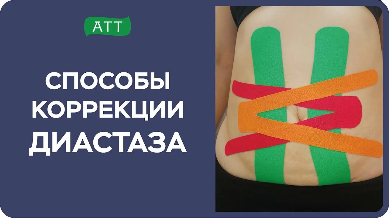 Тейпирование для похудения в домашних условиях. Тейпирование живота при диастазе. Диастаз мышц живота тейпирование. Тейпирование при диастазе прямых мышц живота. Тейпирование диастаза.