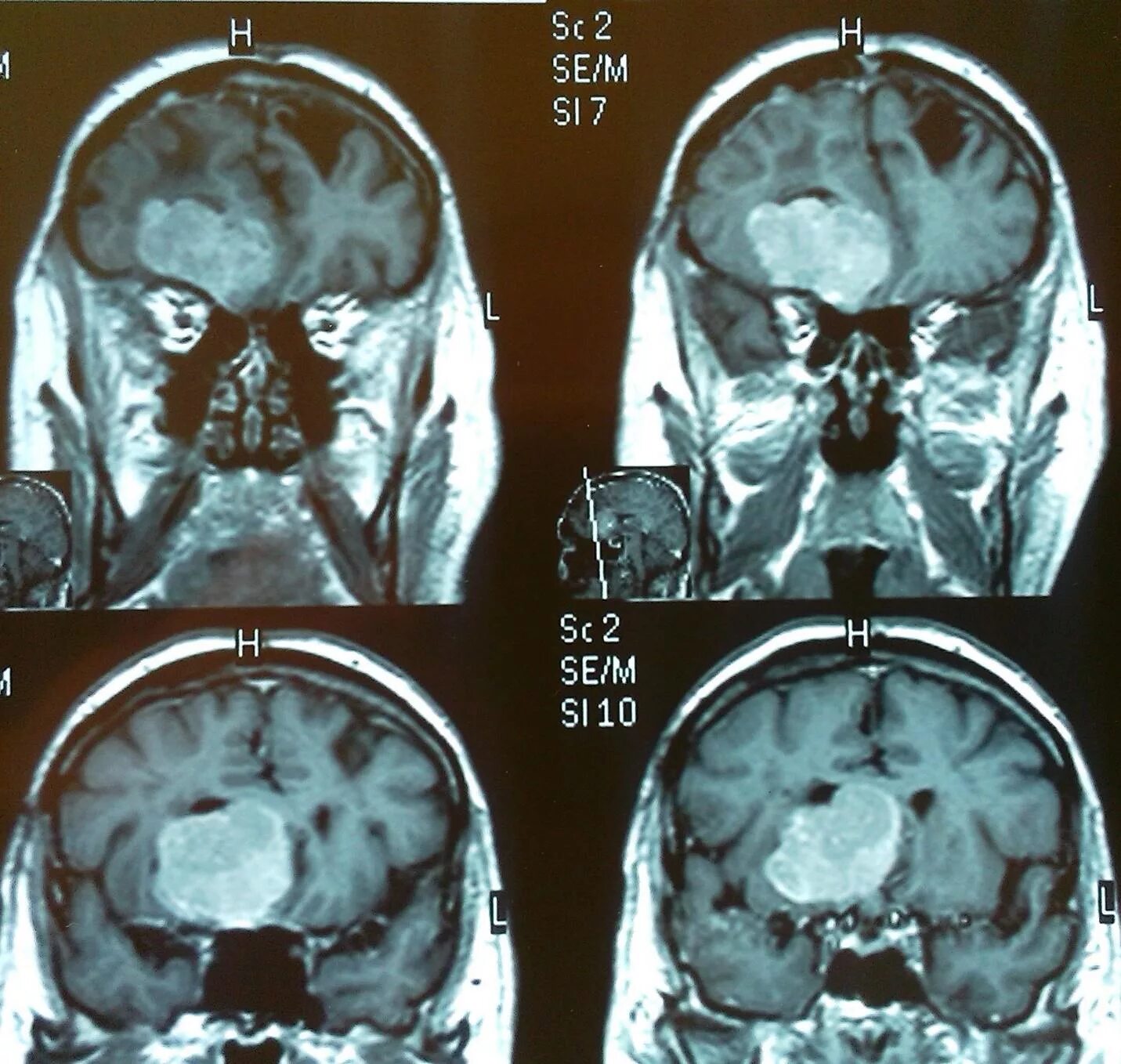 Менингиома головного опухоль. Менингиома основания черепа мрт. Менингиома лобной кости кт. После операции менингиомы головного мозга