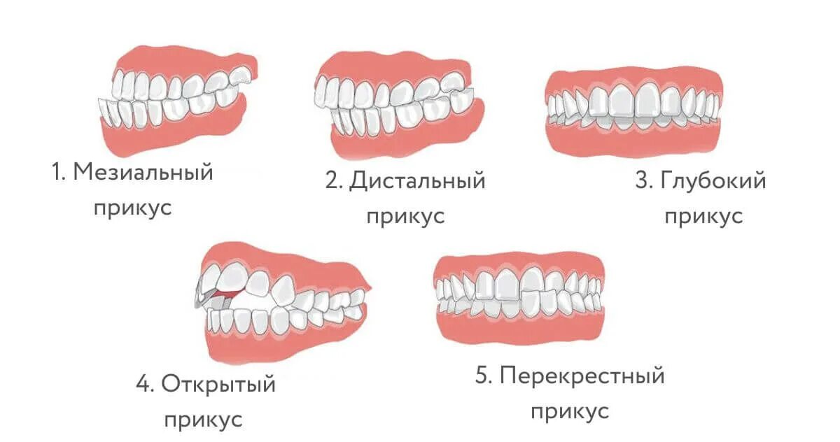 Как понять прикус. Перекрестный прикус зубов у ребенка. глубокий прикус у человека схема. несимметричный прикус.