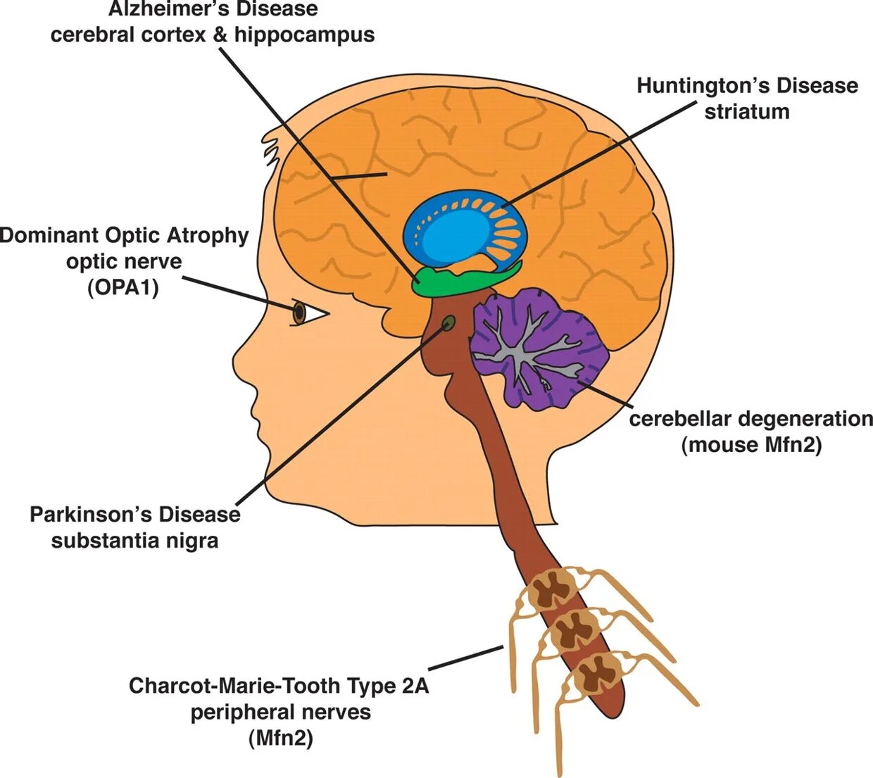 Brain disease