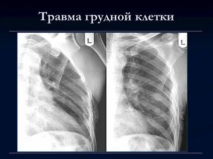 Грудина повреждение
