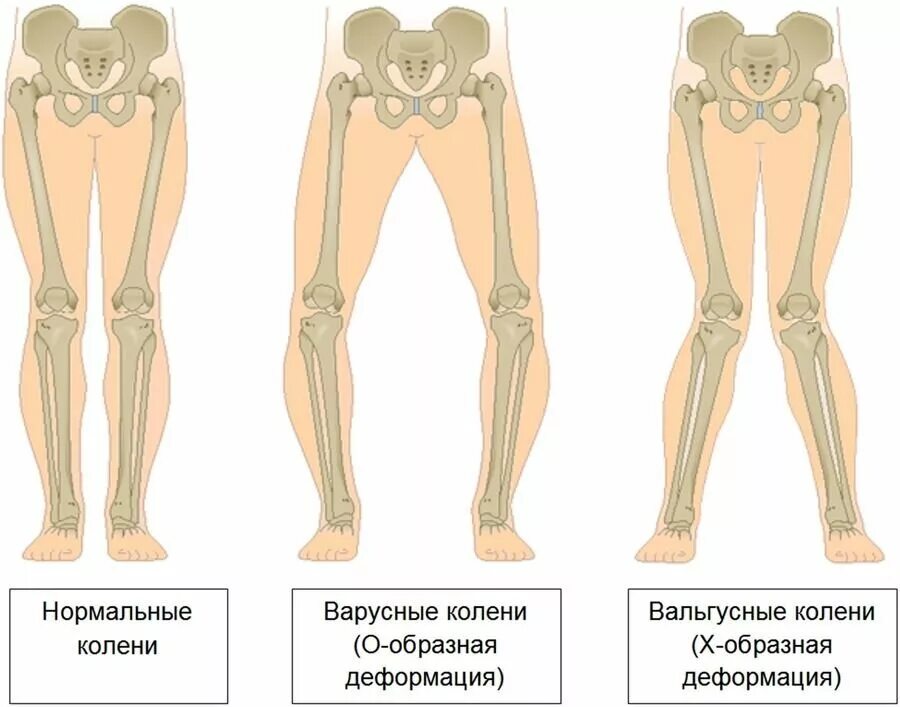 Почему ноги колесом. Варус вальгусная деформация. Вальгусная и варусная деформация ног. Варусная и вальгусная деформация коленного сустава. Варусная деформация бедренной кости.