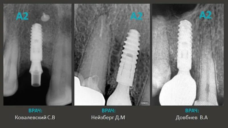 имплантаты а2. имплантаты а2. апекс имплантата это. премиум импланты. All 4 on протезирование зубов.