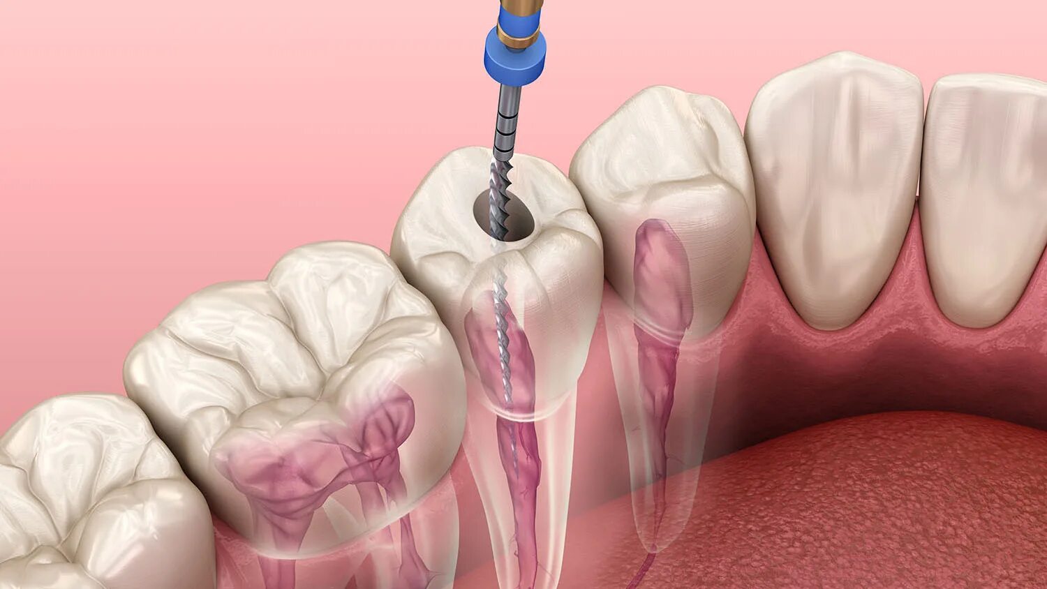 Root canal. Эндодонтическое перелечивание зубов. Пульпит корневого канала.