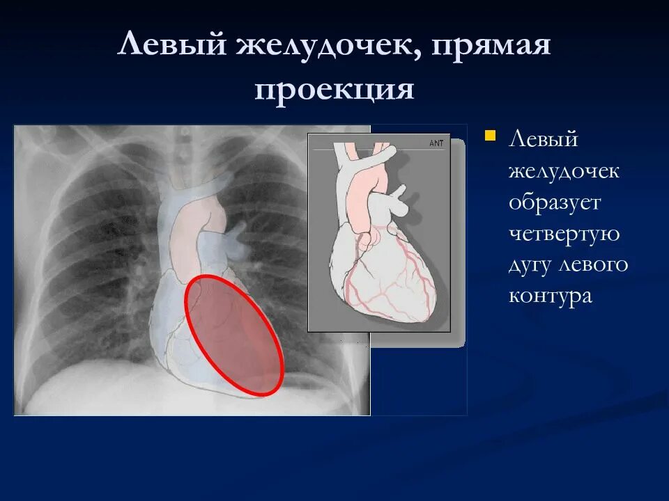 Гипертрофия левого желудочка рентген. Рентген при гипертрофии левого желудочка. Увеличение левого желудочка. Увеличение левого желудочка сердца.