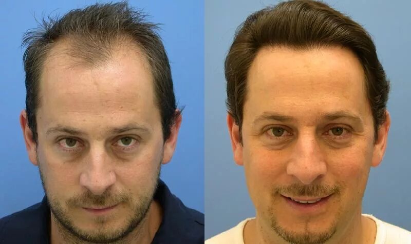 Пересадка волос у женщин до и после Pin on Haartransplantation