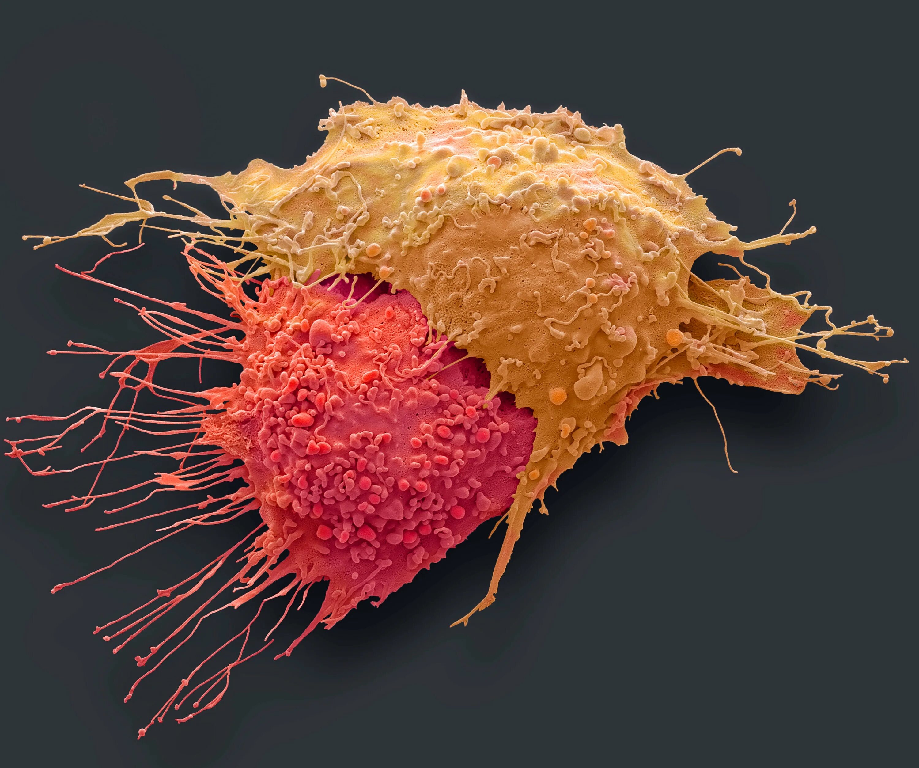 Отличие раковых клеток. Отличия опухолевых клеток. Опухолевые клетки под микроскопом. Отличие раковых клеток. Раковые клетки отличаются от нормальных.