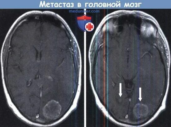 Метастазы в мозгу форум. Единичный метастаз в головном мозге. Метастазы в головной мозг диагноз. Как выглядят метастазы в голове.