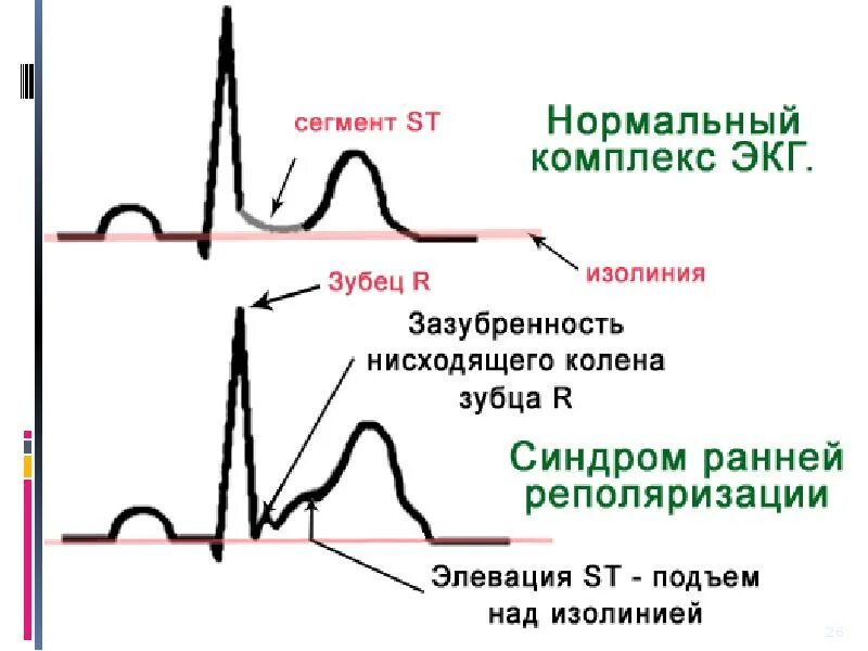 Признаки сррж
