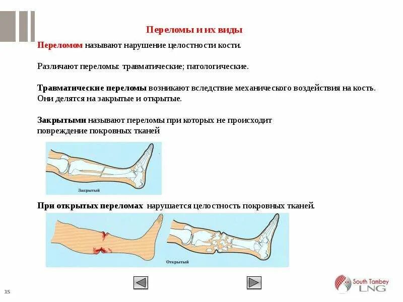 Типы закрытых переломов. Травматические переломы. Травматические переломы костей. Травматические и патологические переломы. Открытые и закрытые переломы.