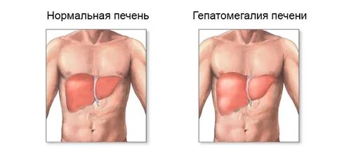 Увеличена селезенка причины и лечение у взрослого