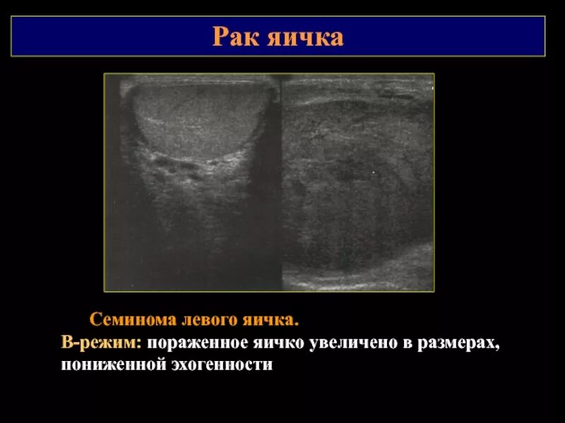 Опухоль яичка семинома. Доброкачественная опухоль яичка УЗИ. Болит в правом яичке у мужчин