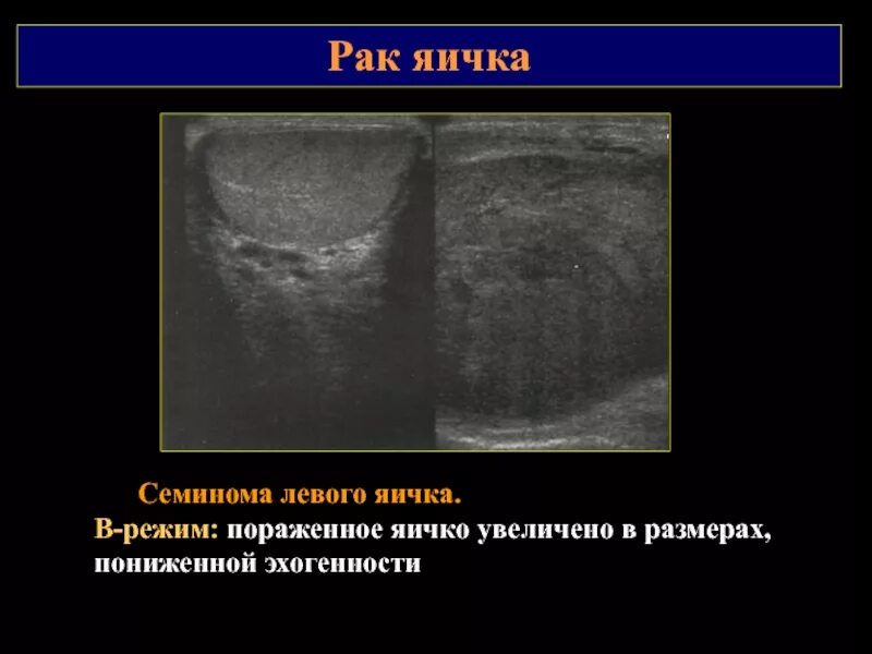 Опухоль яичка семинома. Доброкачественная опухоль яичка УЗИ. Опухло яйцо у мужчины причины