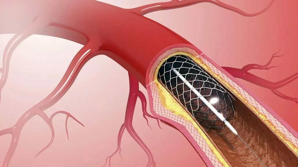 Нитевидный кровеносный сосуд. Эндоваскулярное стентирование коронарных артерий. Xience Alpine стент. Коронарная ангиопластика и стентирование. Операция стентирование сосудов сердца.