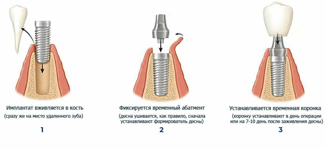 Одномоментная дентальная имплантация. Имплантация формирователь Osstem. Имплантат абатмент коронка формирователь. Одноэтапная методика имплантации.