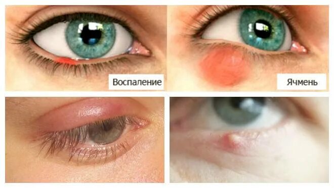 Ячмень на глазу как лечить быстро лекарствами