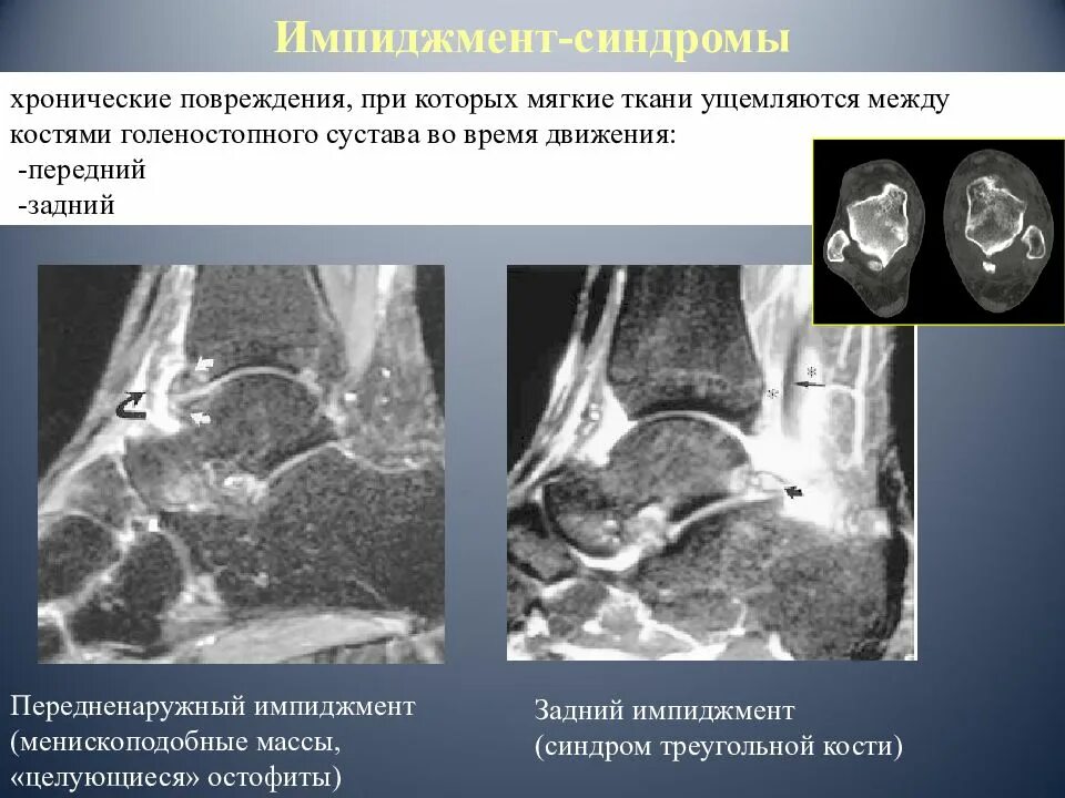 Импиджмент синдром голеностопа. Импинджмент голеностопного сустава мрт. Импинджмент синдром голеностопного сустава мрт. Задний импинджмент голеностопного сустава.