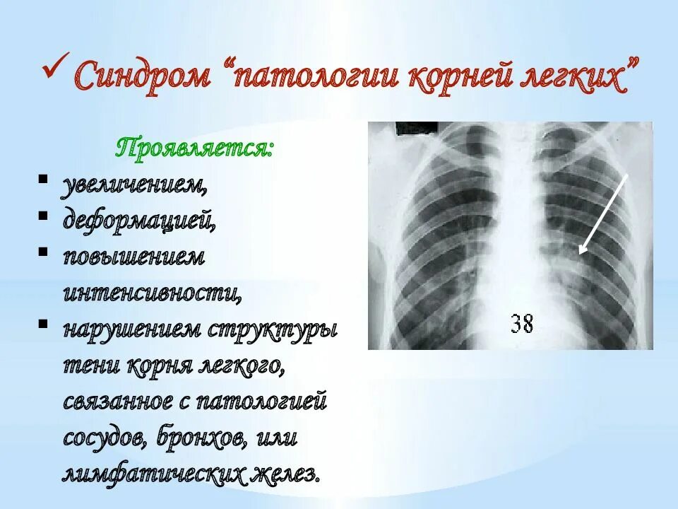 Изменение корня легкого. Патология корня легкого на рентгенограмме. Легочные корни расширены