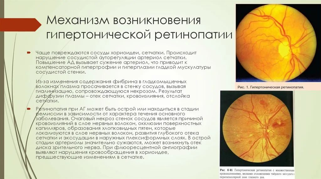 Ангиосклероз сетчатки лечение. Гипертоническая ретинопатия клинические рекомендации. гипертоническая ангиопатия сетчатки диагноз. гипертоническая ангиоретинопатия клинические рекомендации.