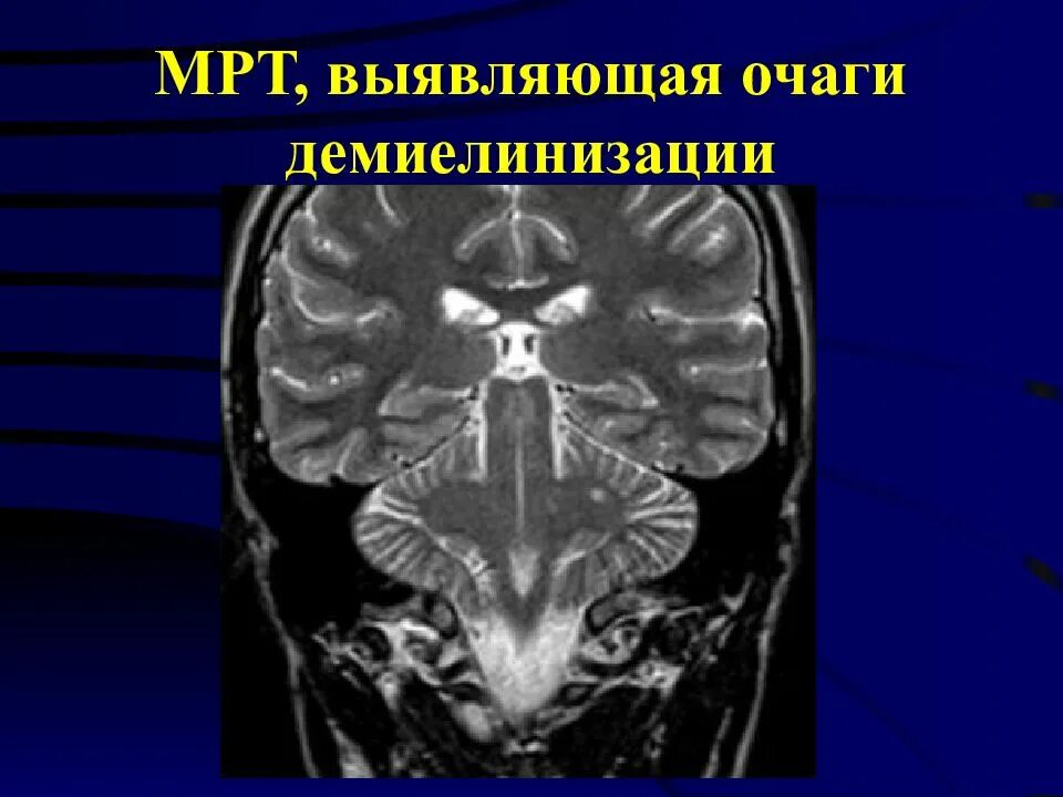 Демиелинизация головного мозга мрт. Очаги демиелинизации головного мозга на мрт. Очаги демиелинизации на кт. Очаги демиелинизации головного мозга что это такое.