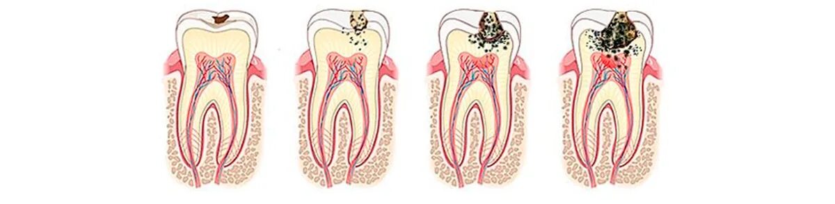 Стадии поражения кариесам. Пульпит стадии лечения. Этапы пульпита периодонтит. Конкрементозный пульпит. Классификация кариес пульпит периодонтит.