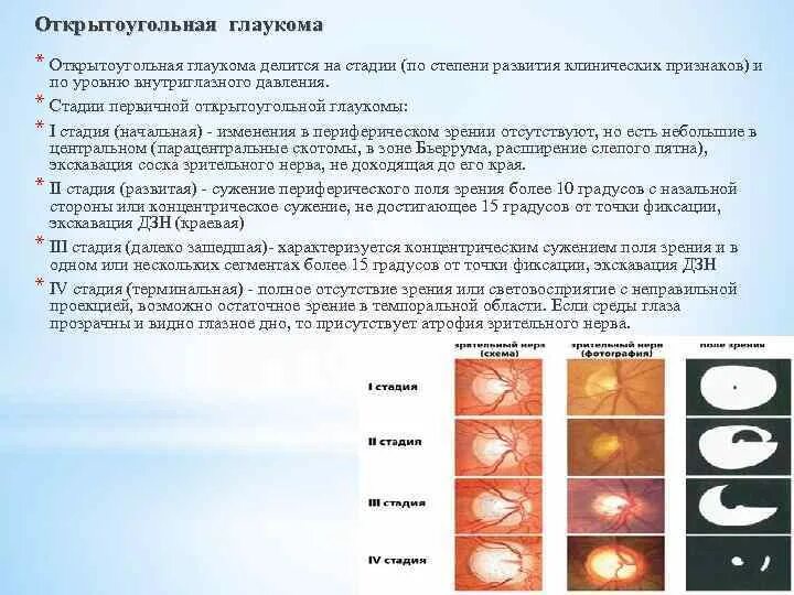 Первичная открытоугольная глаукома 2-3 степени. Первичная открытоугольная глаукома 3а. Стадии открытоугольной глаукомы. Начальная стадия первичной глаукомы. Классификация глаукомы