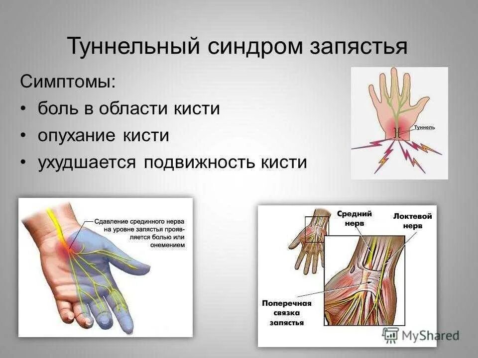 Туннельный синдром запястного канала. Туннельный синдром срединного нерва. Запястный синдром синдром запястного канала. Карпальный туннельный синдром кисти. Синдром карпального канала мкб 10