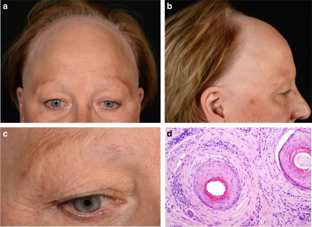 Фронтальная фиброзная алопеция. Постменопаузальная лобная фиброзирующая алопеция.. Фронтальная фиброзная алопеция (ФФА).