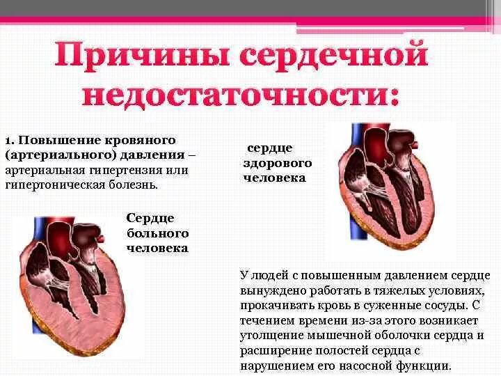 Что значит застойная сердечная недостаточность. Артериальное давление при острой сердечной недостаточности. Хроническая сердечная недостаточность при гипертонической болезни. Причины развития сердечной недостаточности. Причины острой сердечной недостаточности.