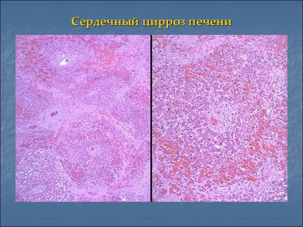 Перицеллюлярный фиброз. Кардиальный фиброз печени на узи. Симптомы при фиброзе печени. Гепатитный цирроз печени. Очаговый фиброз печени.