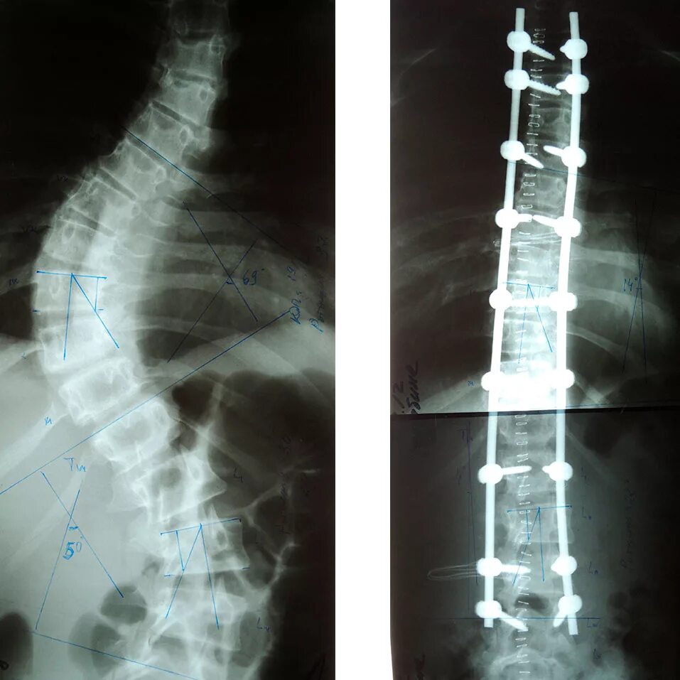 2 операции на позвоночнике. Сколиоз 2 степени рентген. 2-Х пластинчатый эндокорректор рентген. Сколиоз 4 степени рентген. Сколиоз позвоночника 4 степени рентген.