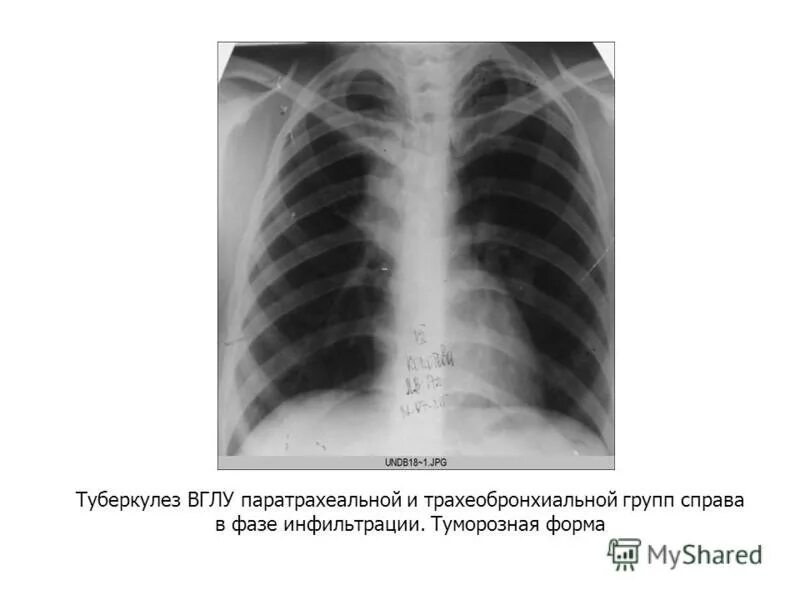 Ru туберкулез. Внутригрудные лимфатические узлы туберкулез. Инфильтративный туберкулез и внутригрудных лимфоузлов. Туберкулез внутригрудных узлов рентген. Туморозная форма туберкулеза внутригрудных лимфатических узлов.