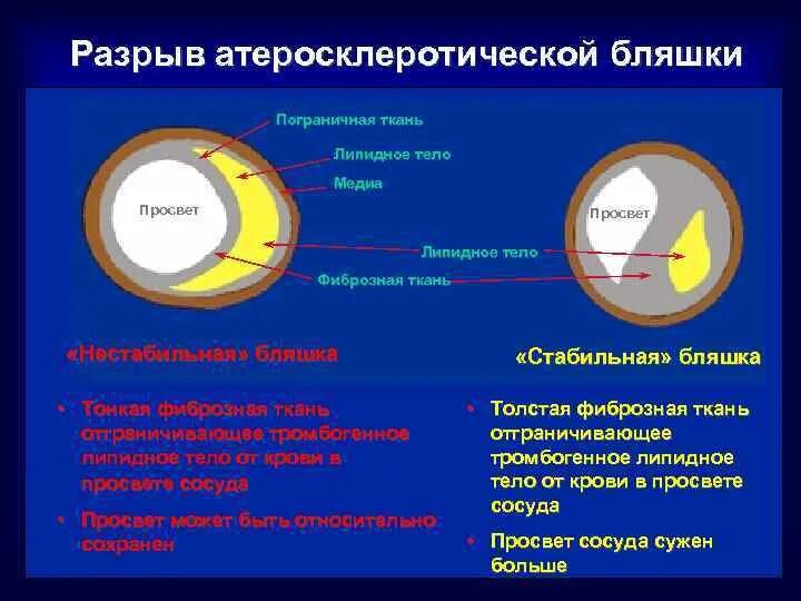 Стабильная и нестабильная атеросклеротическая бляшка. Строение стабильной и нестабильной атеросклеротической бляшки. Строение атеросклеротической бляшки. Структура атеросклеротической бляшки.