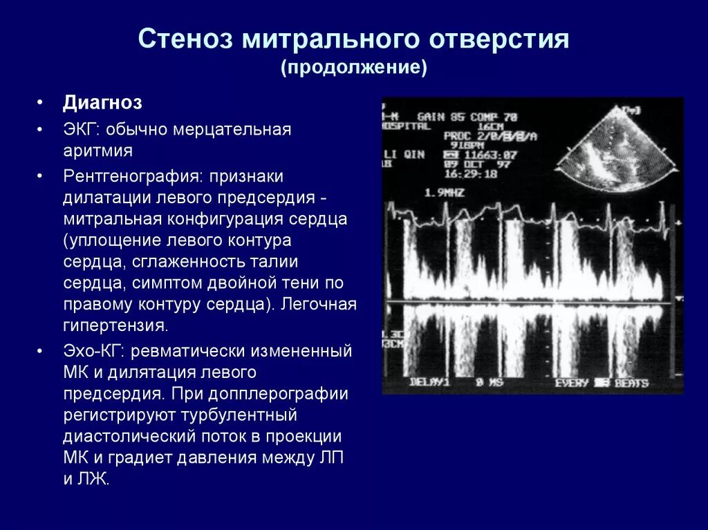 Митральный стеноз признаки. Митральный стеноз эхокардиография. Приобретенные пороки сердца в ЭХОКГ. Эхокардиография стеноз митрального клапана. Оценка стеноза митрального клапана эхокардиография.