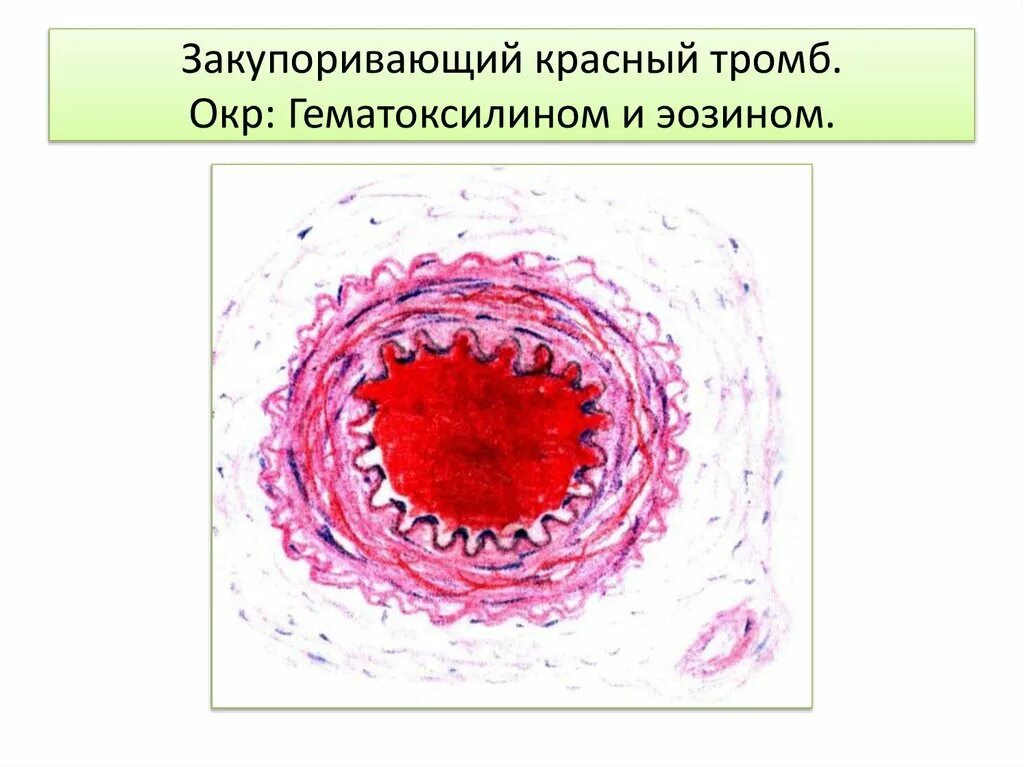 Красный тромб патологическая анатомия. Строение тромба