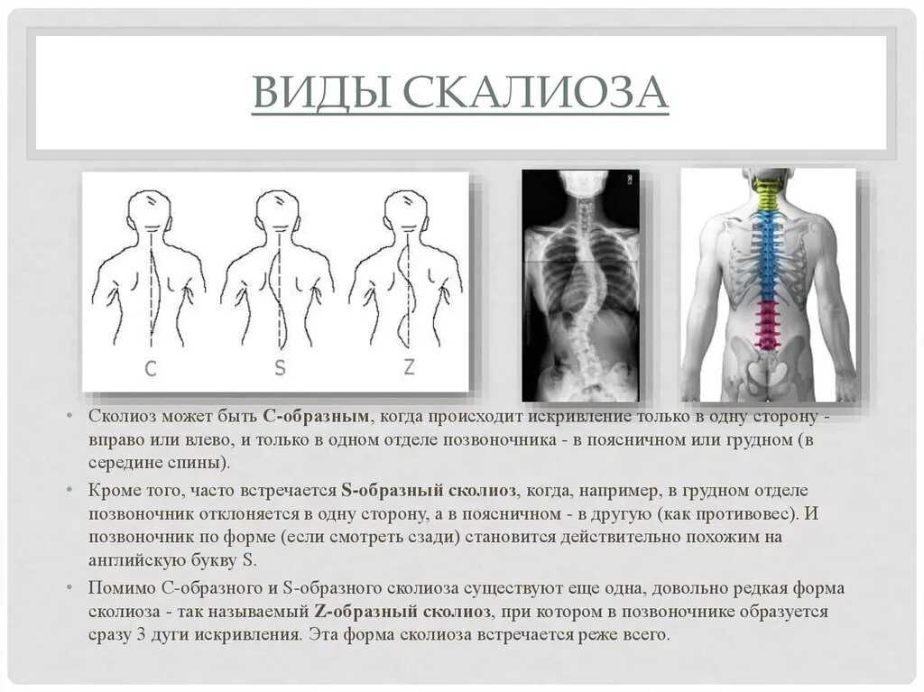 Дорзалгия. Лекарство при искривлении позвоночника сколиоза 1 степени. Сколиоз позвоночника s образный грудного. ЛФК сколиоз 3 степени s образный. Z- образный сколиоз (с тремя дугами искривления);.