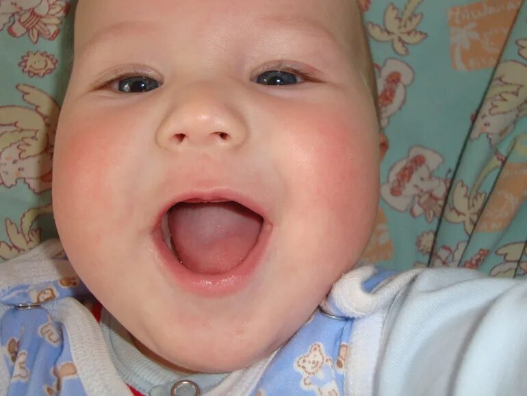 Афтозный афтозный стоматит. Периоды прорезывания временных зубов. Сыпь при прорезывании зубов у детей. Цефалический пустулез. Сыпь на зубы у ребенка.