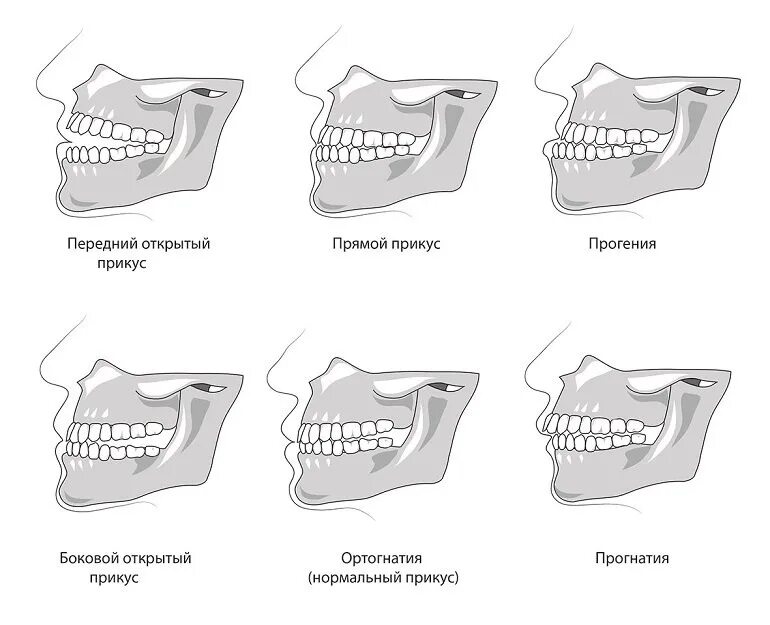 Правильный прикус у человека схема сбоку. Правильный прикус зубов у человека схема. Открытый боковой прикус, открытый прямой прикус. Зубы нижней челюсти прикус. Челюсть на английском
