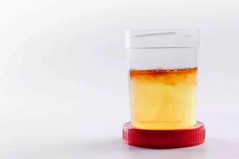 Los expertos advierten: si tu orina sale de un color, ve cuánto antes al médico