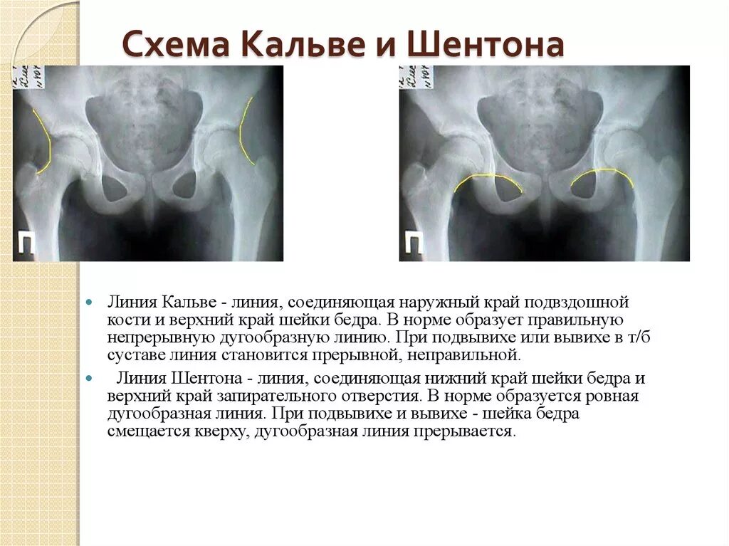 Тазобедренные суставы тип 2а