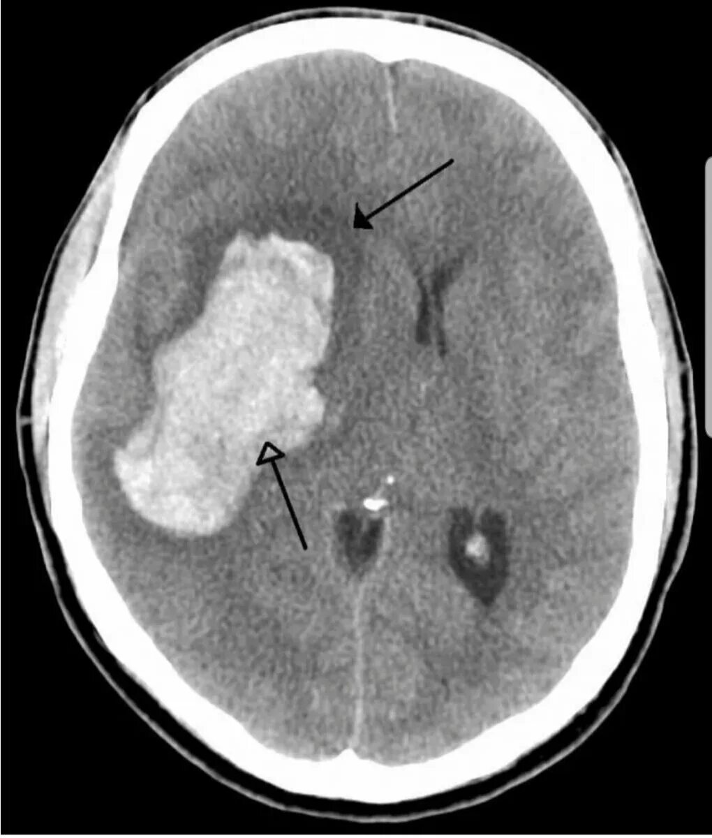 Кт ГМ геморрагический инсульт. Ишемический инсульт снимок кт. Ишемический инсульт на кт головного мозга. Геморрагический инсульт кт снимок. Кровь после кт