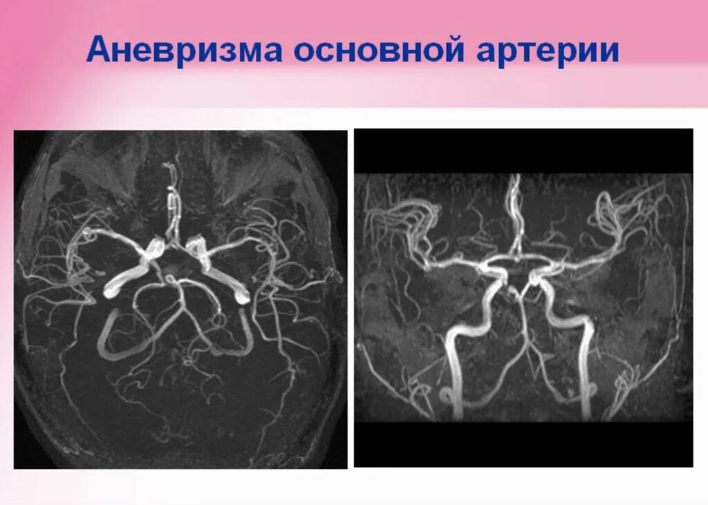 Аневризма сонной артерии что это. Аневризмы базилярной артерии. Аневризма бифуркации базилярной артерии. Мрт ангиография аневризма внутренней сонной артерии. Фузиформная аневризма базилярной артерии кт.