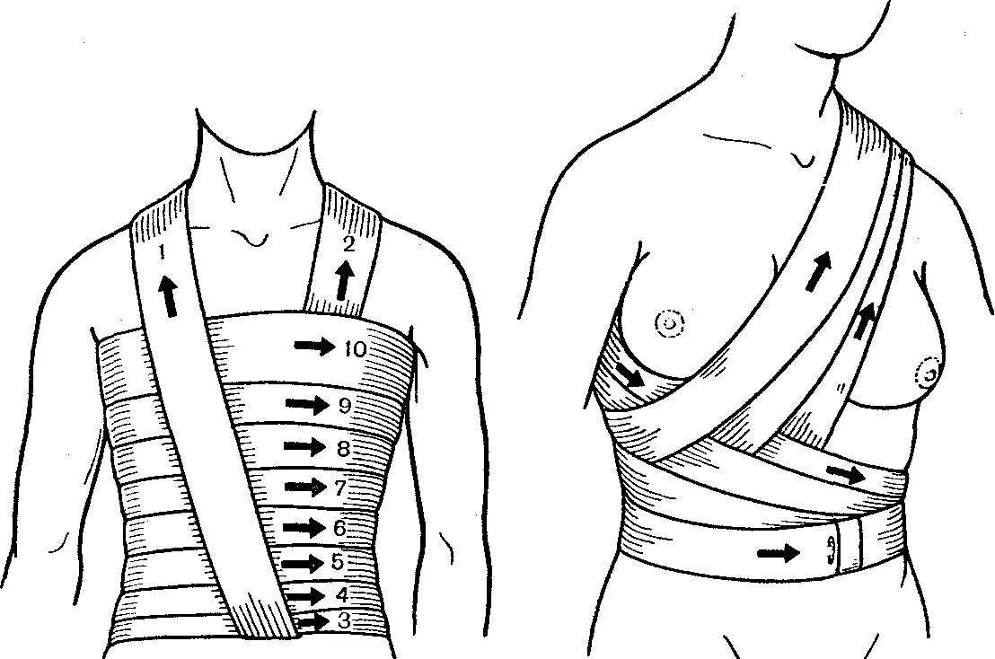Техника наложения повязок на грудную клетку. Техника наложения окклюзионной повязки на грудную клетку. Спиралевидная повязка на грудную клетку. Спиральная перевязка грудной клетки. Перевязка десмургия на молочную железу.