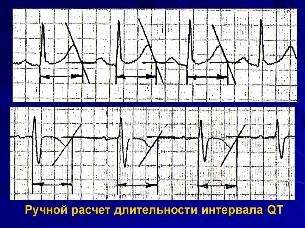 Удлиненное qt на экг. Qt корригированный на ЭКГ. Интервал qt на ЭКГ. Корригированный интервал qt на ЭКГ. Интервал qt на ЭКГ норма.